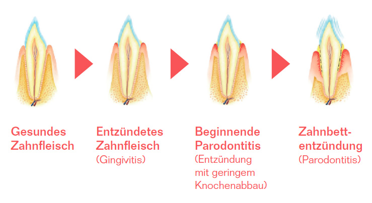 Die vier Phasen der Zanhentzündung